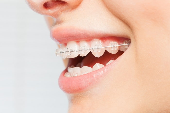 Ceramic Braces Honey Orthodontics in Gurnee, IL