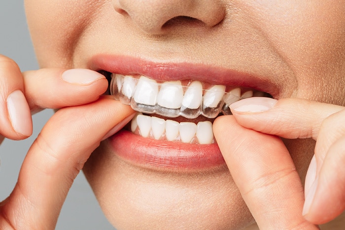 Invisalign Clear Aligners Honey Orthodontics in Gurnee, IL