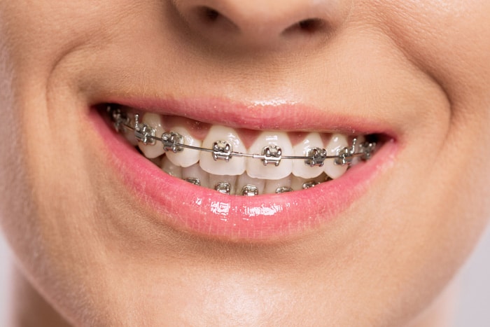 Metal Braces Honey Orthodontics in Gurnee, IL