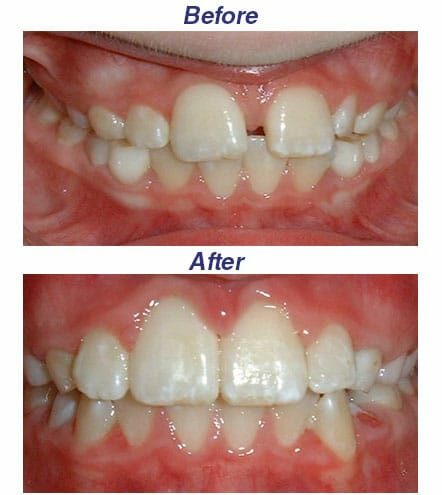Before and After - Honey Orthodontics in Gurnee, IL.