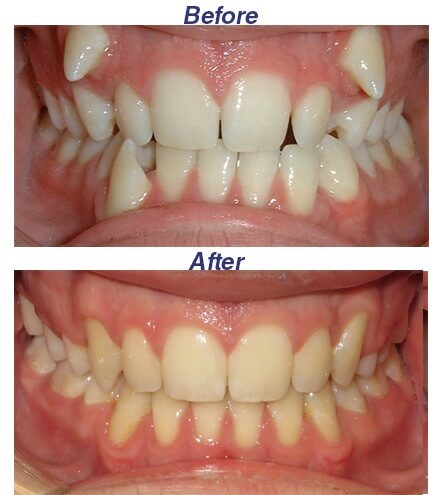 Before and After - Honey Orthodontics in Gurnee, IL.