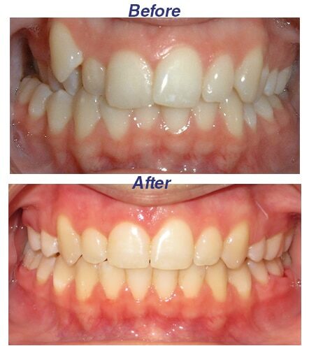 Before and After - Honey Orthodontics in Gurnee, IL.