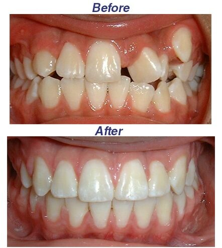 Before and After - Honey Orthodontics in Gurnee, IL.