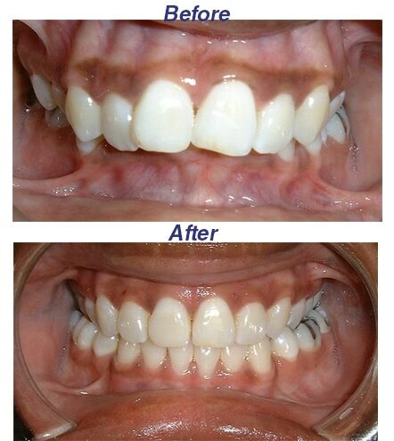 Before and After - Honey Orthodontics in Gurnee, IL.