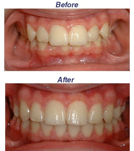 Before and After - Honey Orthodontics in Gurnee, IL.