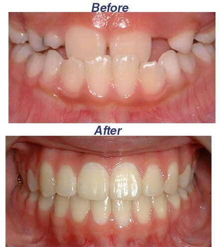 Before and After - Honey Orthodontics in Gurnee, IL.