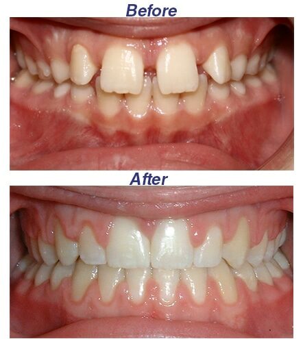 Before and After - Honey Orthodontics in Gurnee, IL.