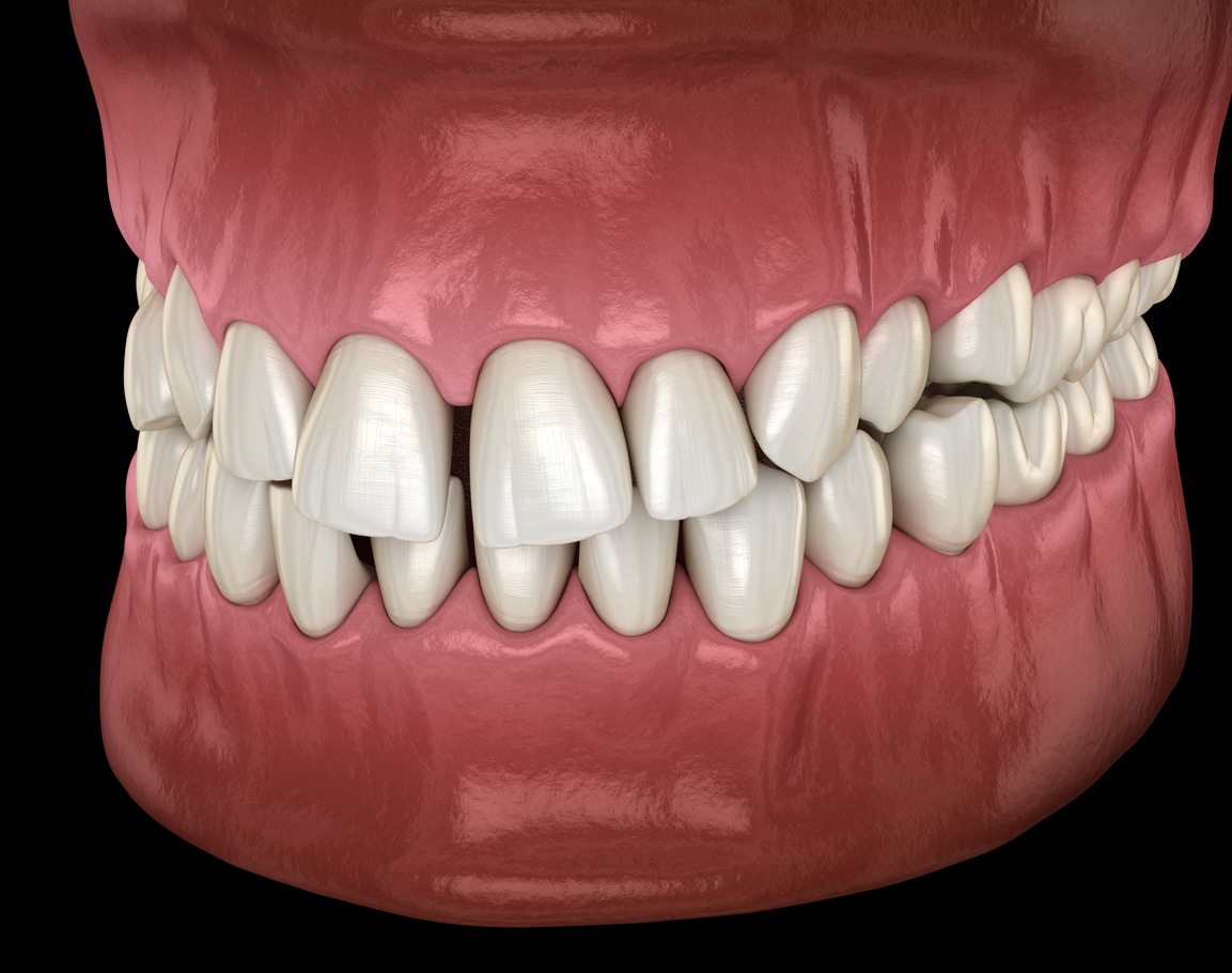 Common Problems Spacing Honey Orthodontics in Gurnee, IL