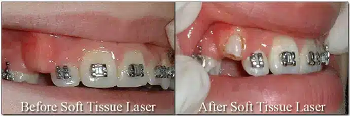 Before and After Soft Tissue Laser Honey Orthodontics in Gurnee, IL